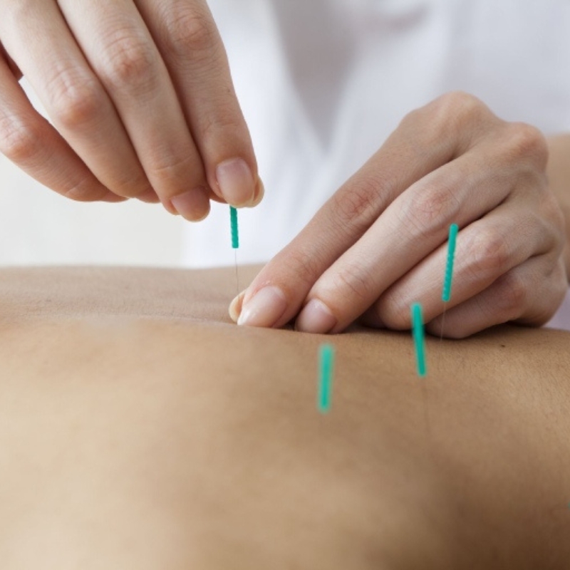 Kim châm cứu