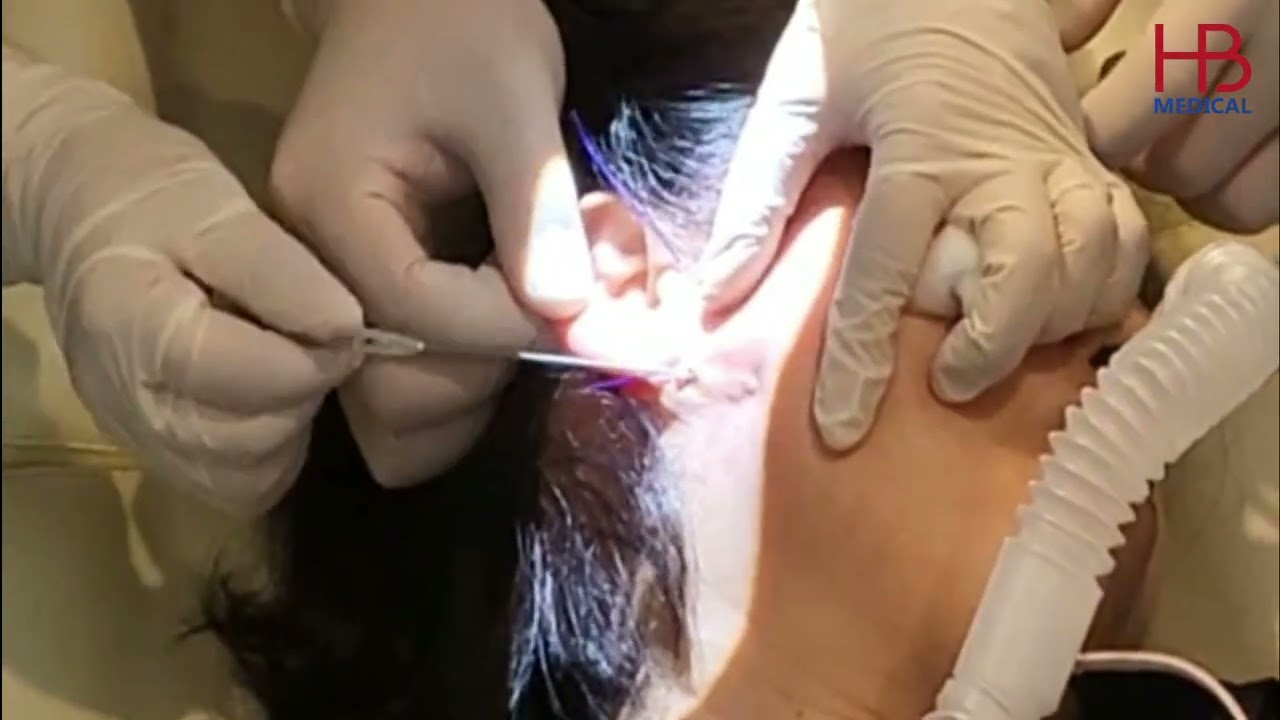 Kĩ thuật nâng cơ má chảy xệ với chỉ CUTTING COG |HB Medical