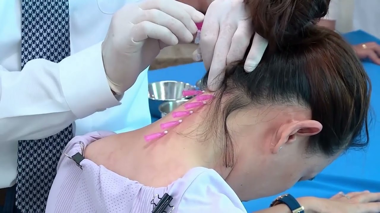 Cấy chỉ điều trị đau cổ vai gáy với chỉ MONO I HB Medical