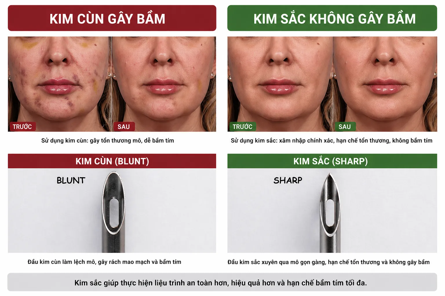 So sánh kim sắc và kim cùn trong 1 liệu trình