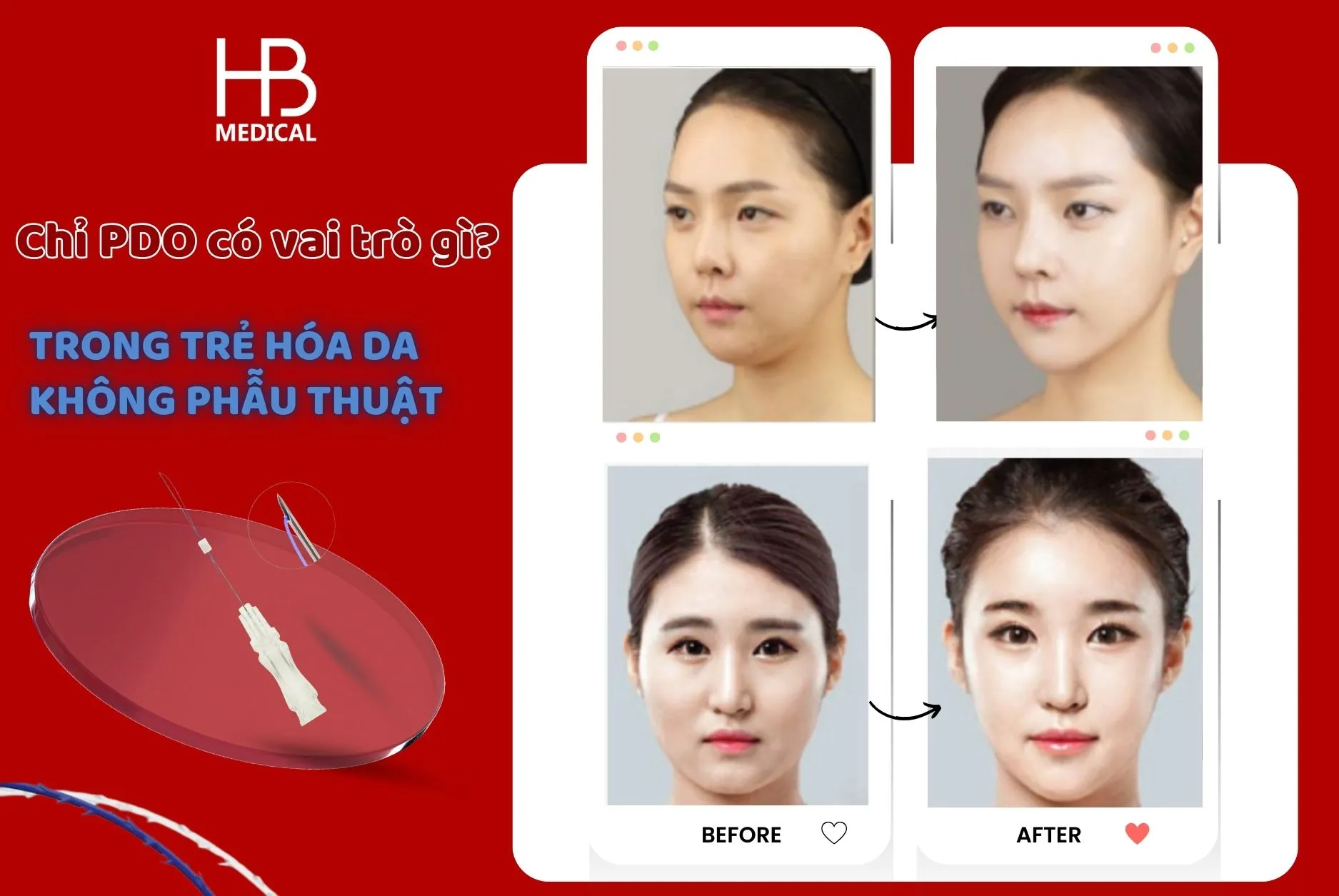 Chỉ PDO có vai trò gì trong trẻ hóa da không phẫu thuật?