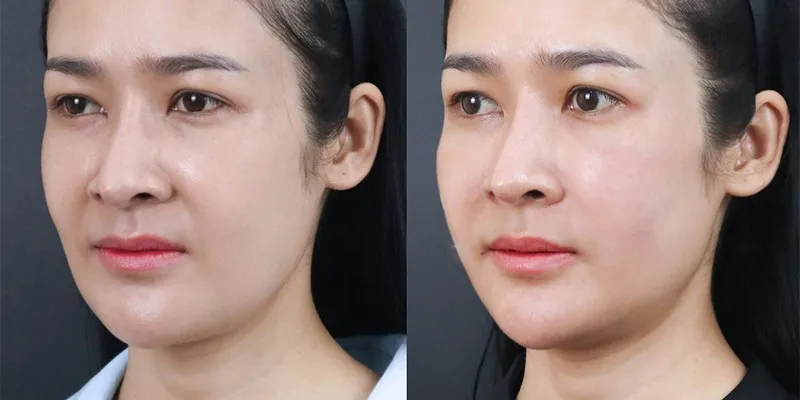 Ca nâng cơ thực tế