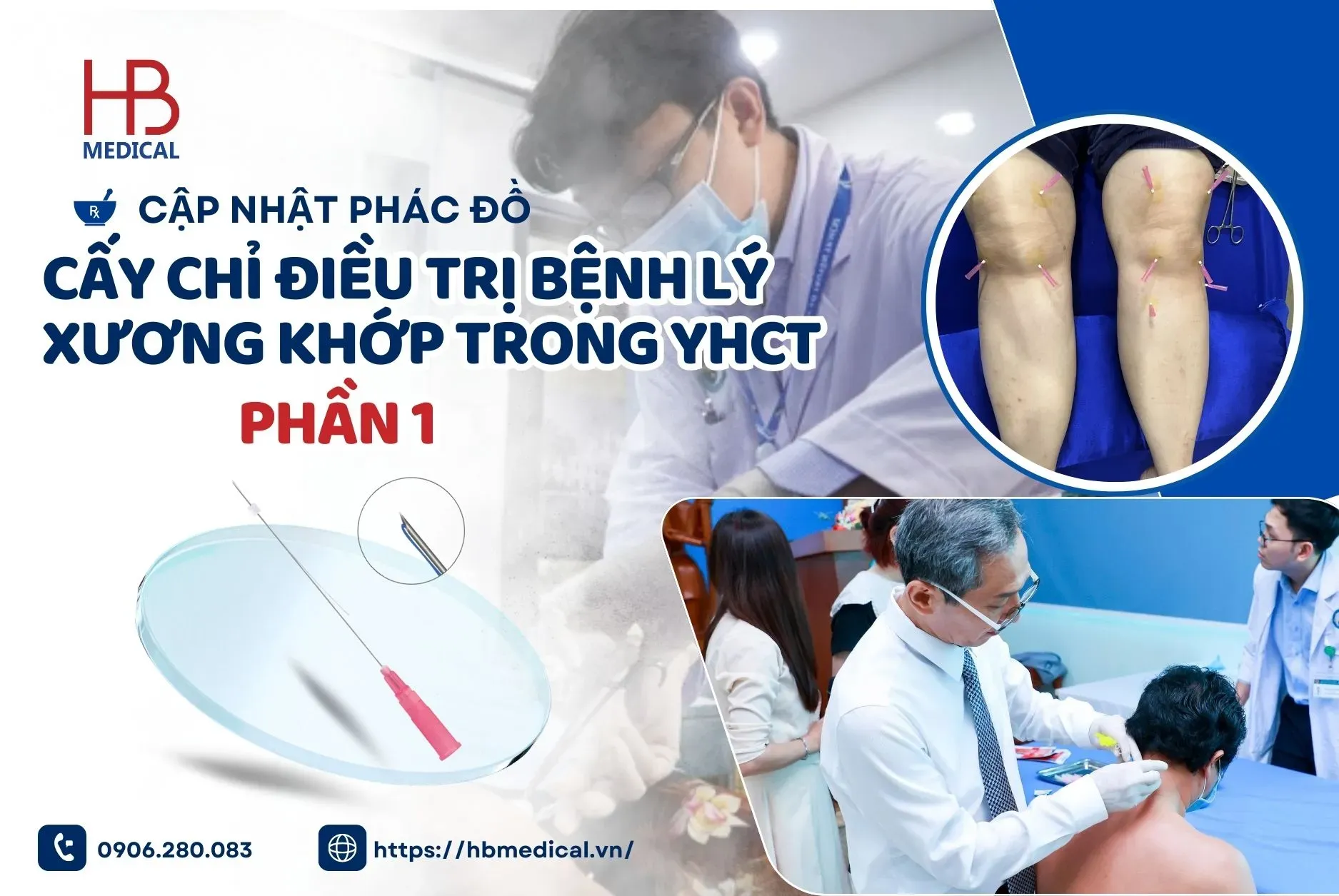 Cập nhật phác đồ cấy chỉ điều trị bệnh lý xương khớp trong YHCT