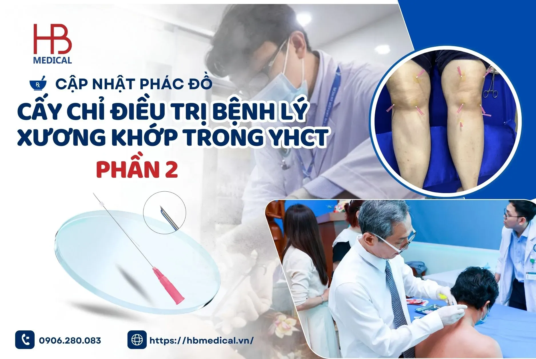 Cập nhật phác đồ cấy chỉ điều trị bệnh lý xương khớp trong YHCT
