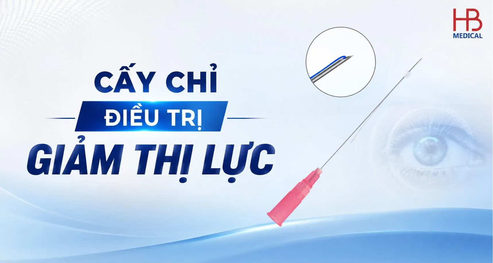 Cấy chỉ điều trị giảm thị lực