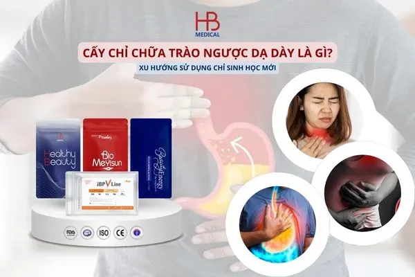 Cấy Chỉ Chữa Trào Ngược Dạ Dày Là Gì? Xu Hướng Sử Dụng Chỉ Sinh Học Mới Trong Điều Trị
