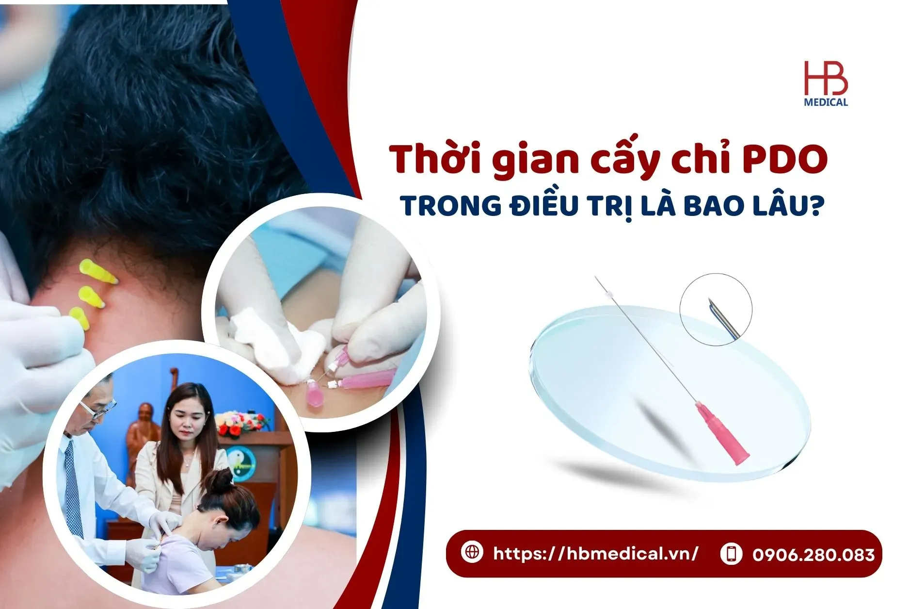 Thời gian cấy chỉ PDO trong điều trị là bao lâu?