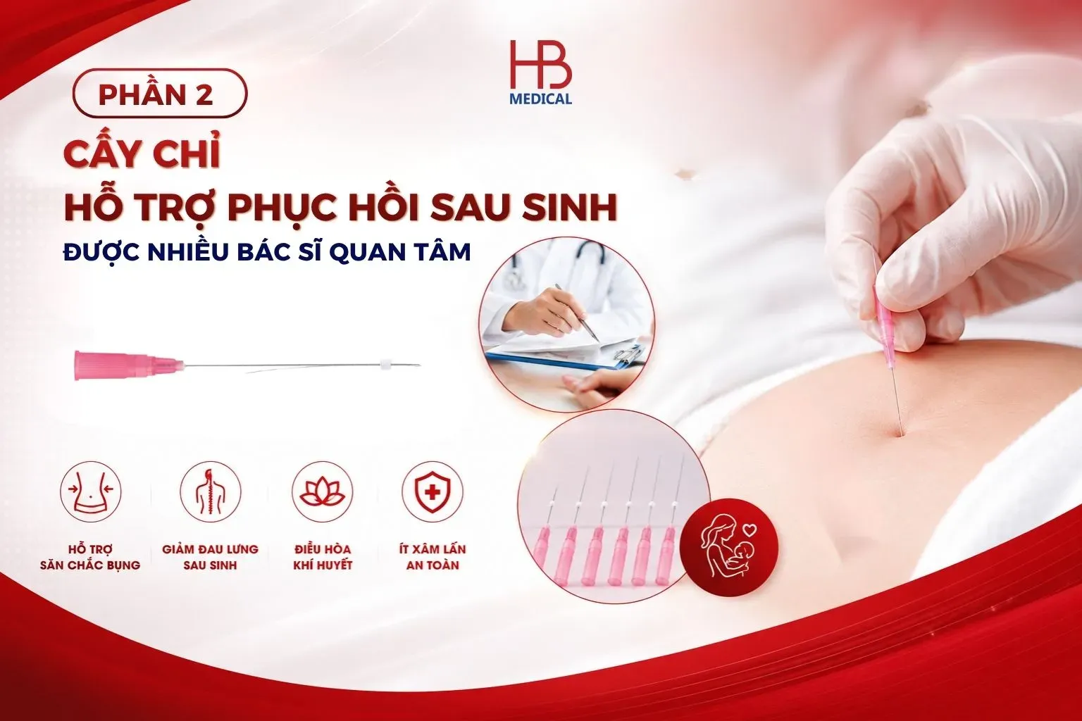Cấy chỉ sau sinh bao lâu thì phù hợp
