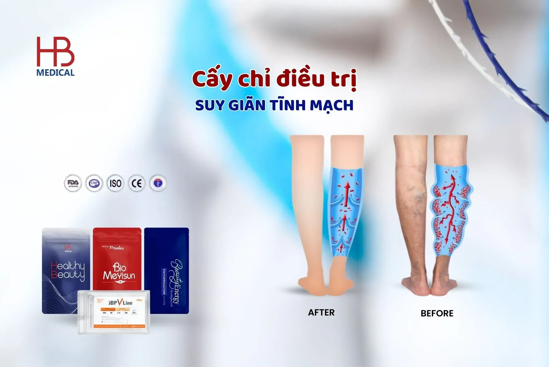 Cấy chỉ trị suy giãn tĩnh mạch