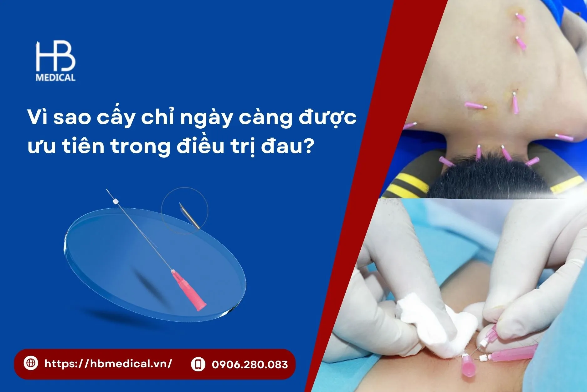 Vì sao cấy chỉ ngày càng được ưu tiên trong điều trị đau?