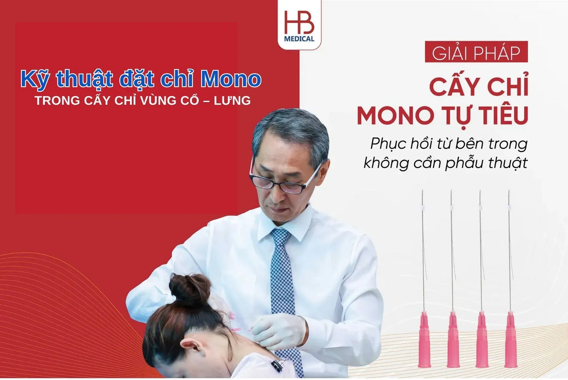 Kỹ thuật đặt chỉ Mono an toàn trong cấy chỉ vùng cổ – lưng