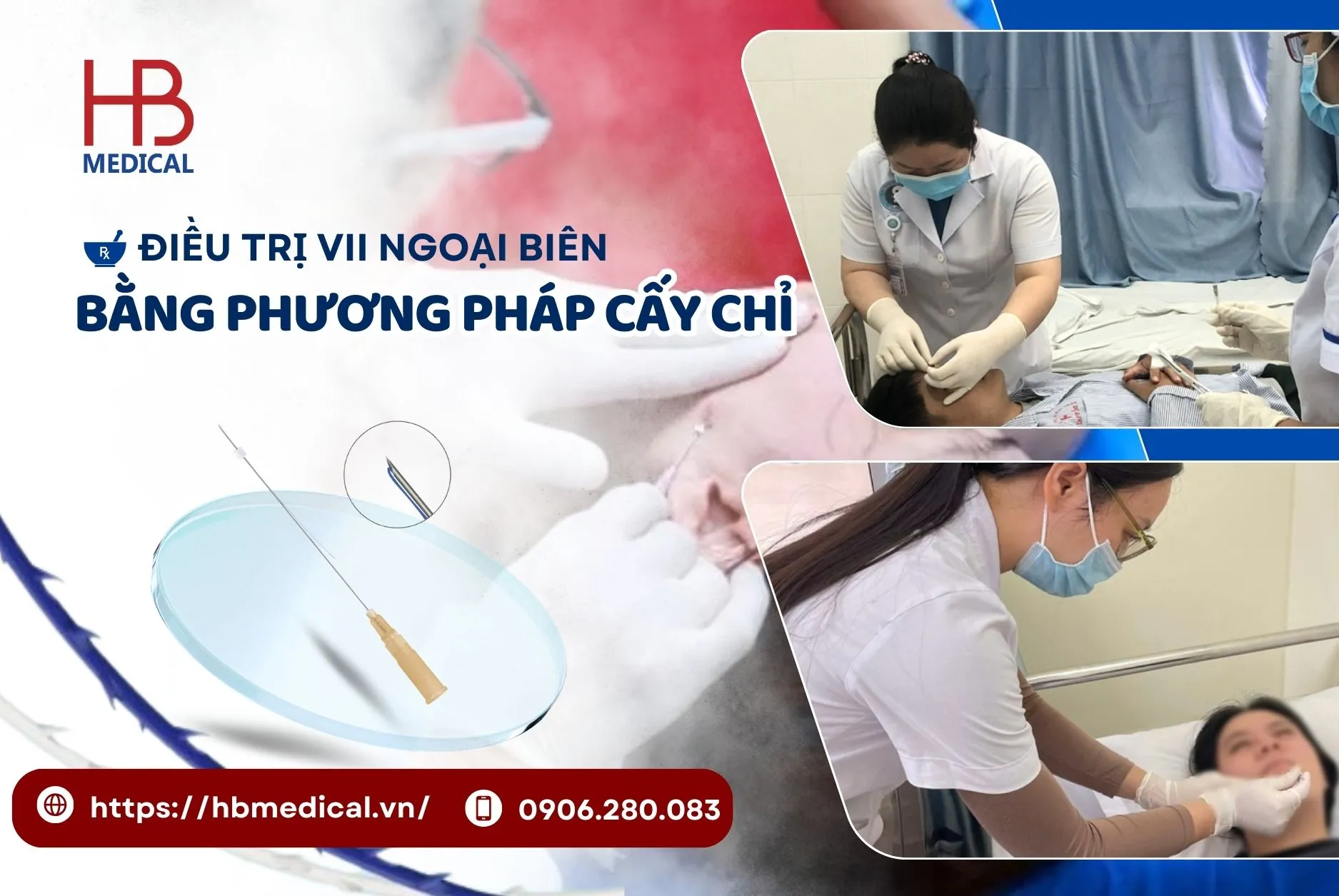 Điều trị VII ngoại biên bằng phương pháp cấy chỉ