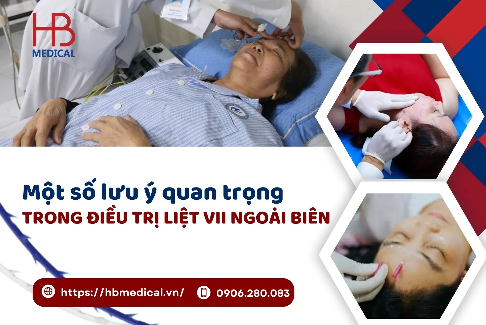 Lưu ý quan trọng trong điều trị liệt VII ngoại biên