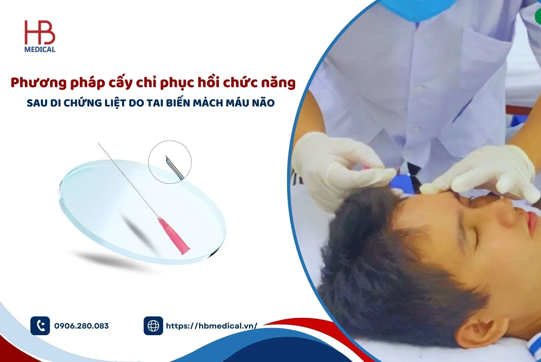 Phương pháp cấy chỉ phục hồi chức năng sau di chứng liệt do tai biến mạch máu não