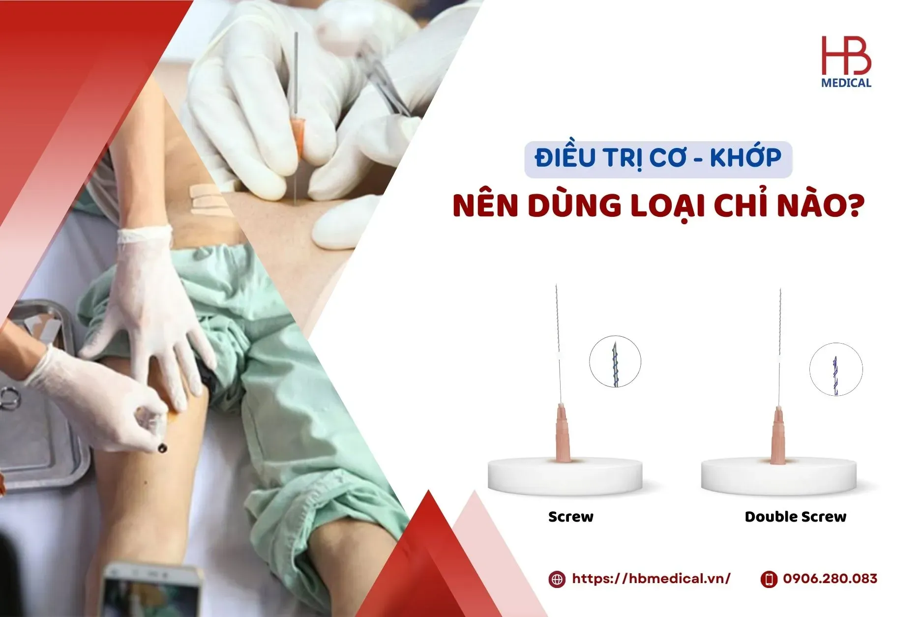 Điều trị cơ - khớp nên dùng loại chỉ nào?