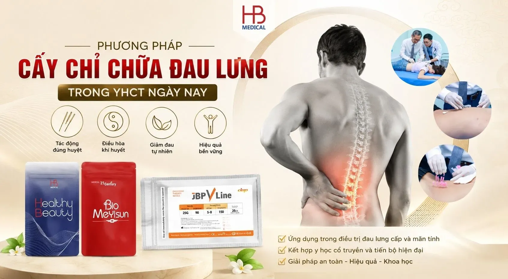 Cấy chỉ chữa đau lưng trong Y Học Cổ Truyền
