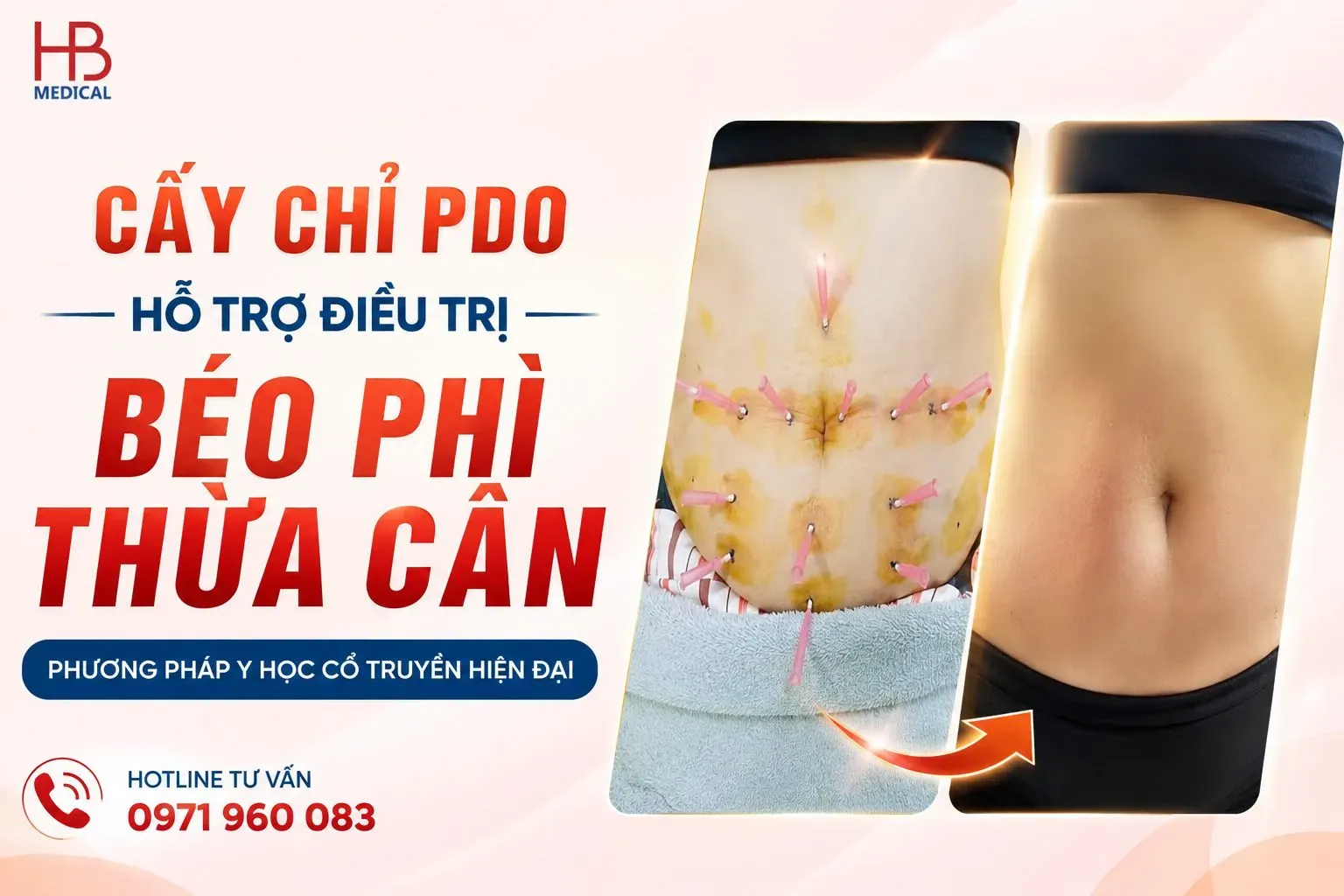 Cấy chỉ điều trị béo phì/ thừa cân
