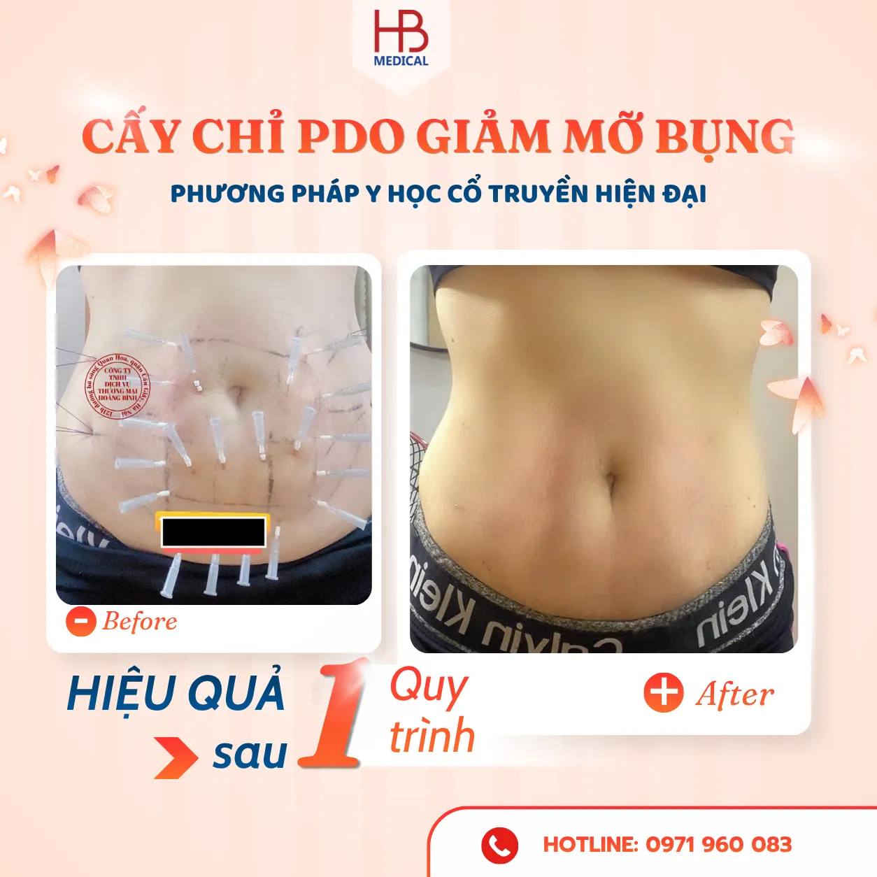 Cấy chỉ điều trị sau một liệu trình