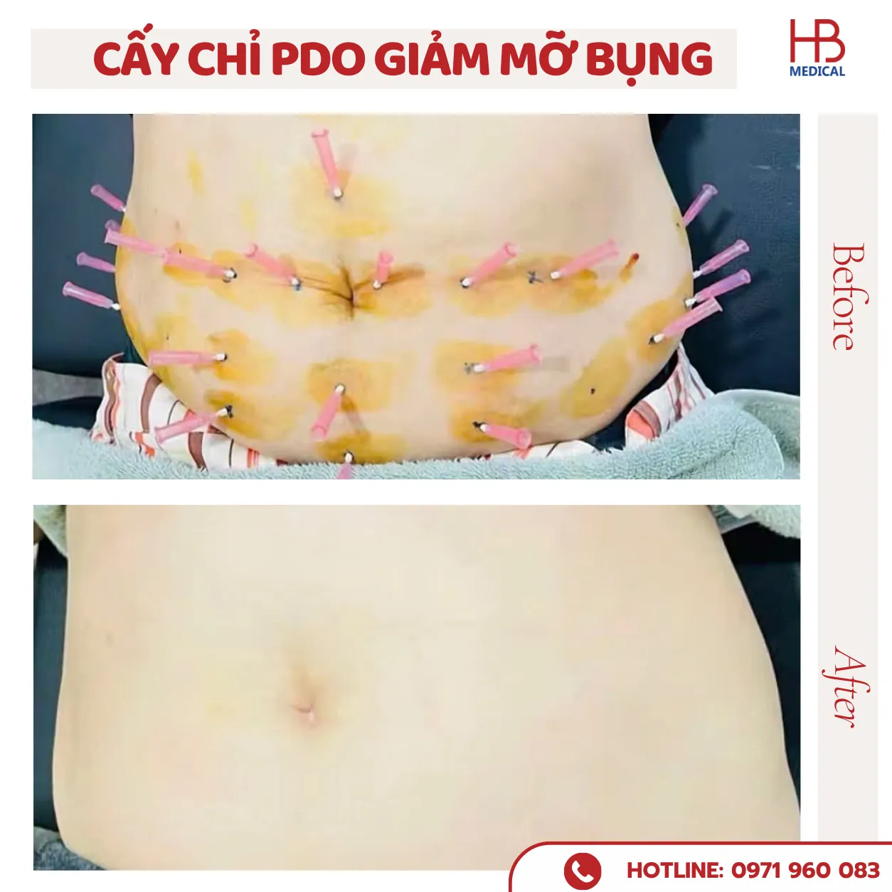 Hiệu quả sau cấy chỉ 10 ngày! 