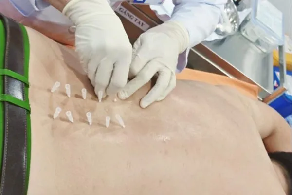 Cấy chỉ giúp giản tần suất đi tái khám nhiều lần 