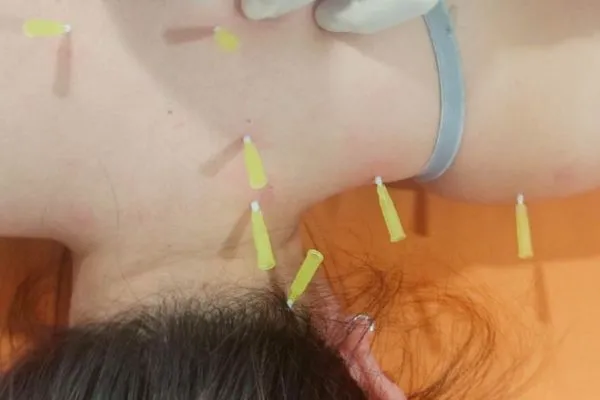Cấy chỉ điều trị các bệnh đau mãn tính