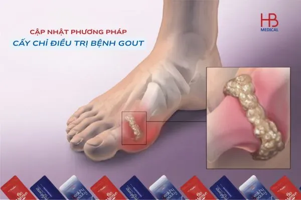 Cấy chỉ điều trị bệnh gút