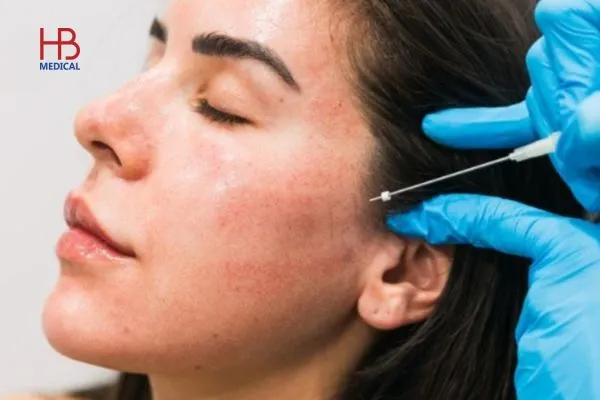 Quy trình căng chỉ vùng mắt được thực hiện bởi chuyên gia