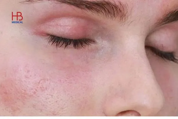 Một số rủi ro thường gặp khi căng chỉ vùng mắt