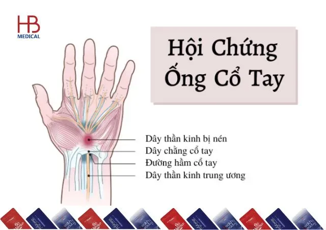 Cấy chỉ trong điều trị hội chứng ống cổ tay