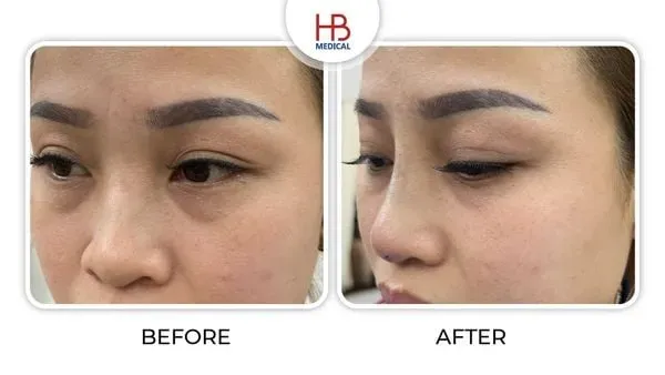 Hình ảnh thực tế trước và sau khi nâng mũi bằng chỉ