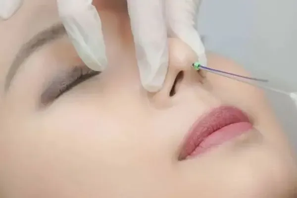 Nâng mũi bằng chỉ là gì?