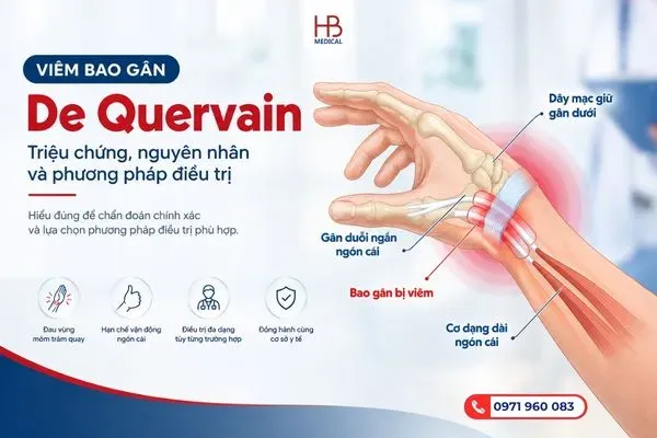 Cấy chỉ điều trị viêm bao gân De Quervain