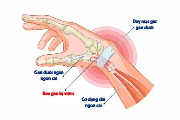Viêm bao gân De Quervain là gì? 