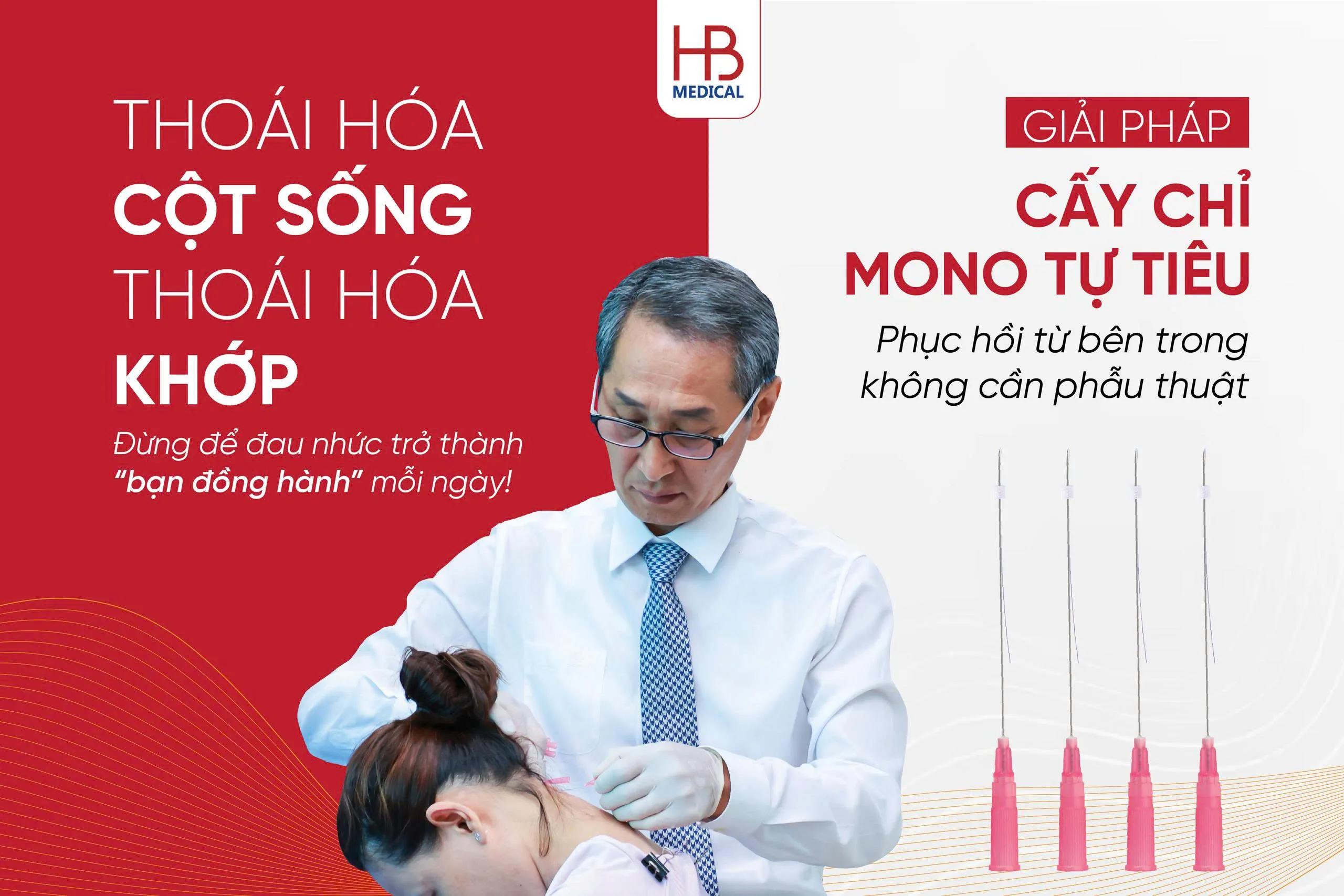 Chỉ Mono - giải pháp cấy chỉ chữa bệnh xương khớp