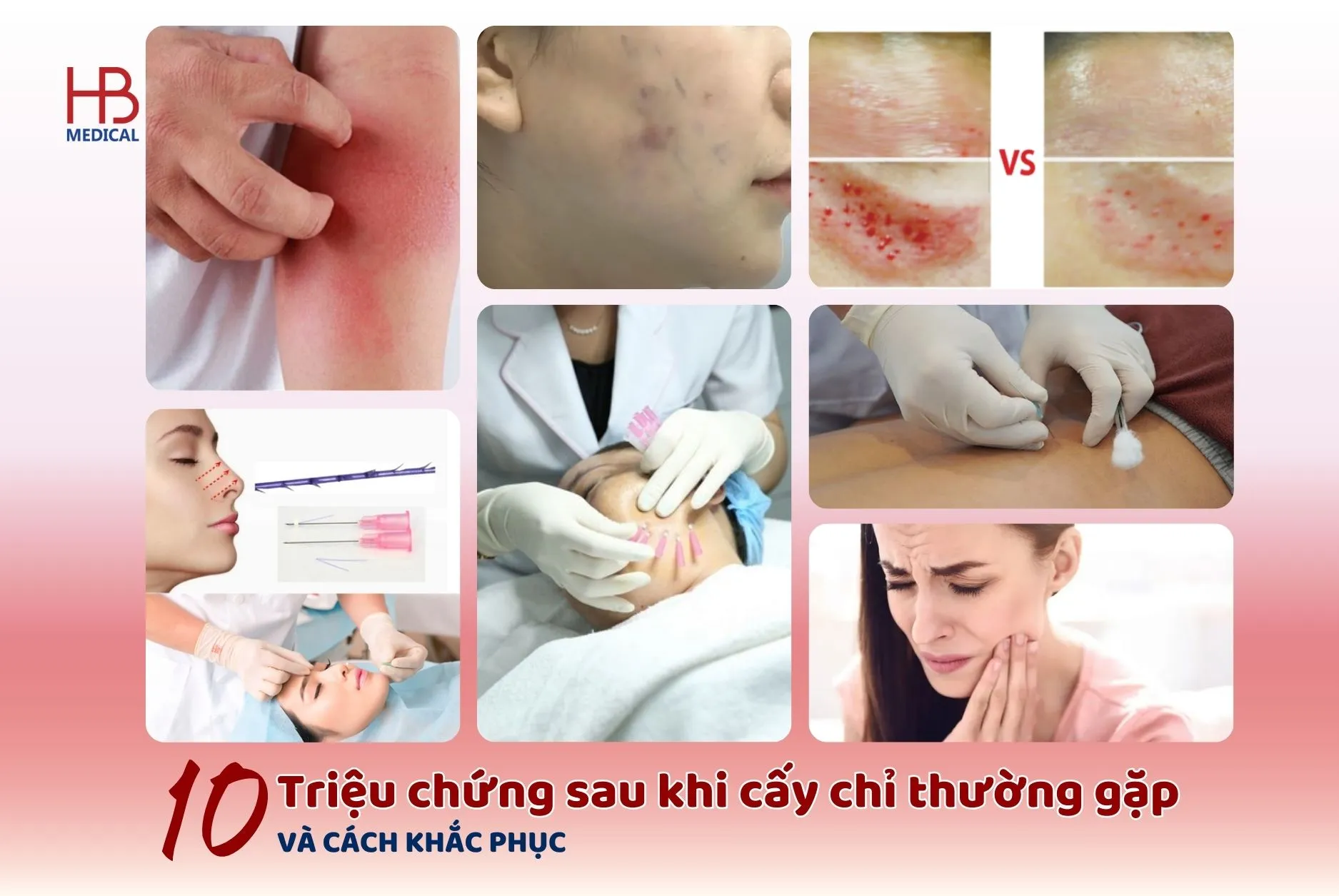 10 triệu chứng sau khi cấy chỉ thường gặp và cách khắc phục