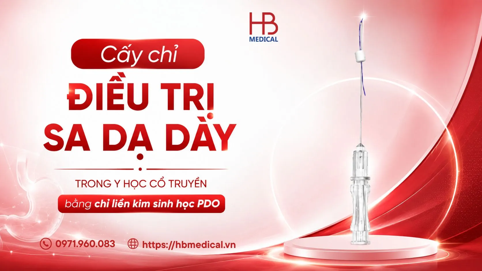 Cấy chỉ điều trị sa dạ dày trong Y học cổ truyền bằng chỉ liền kim sinh học PDO