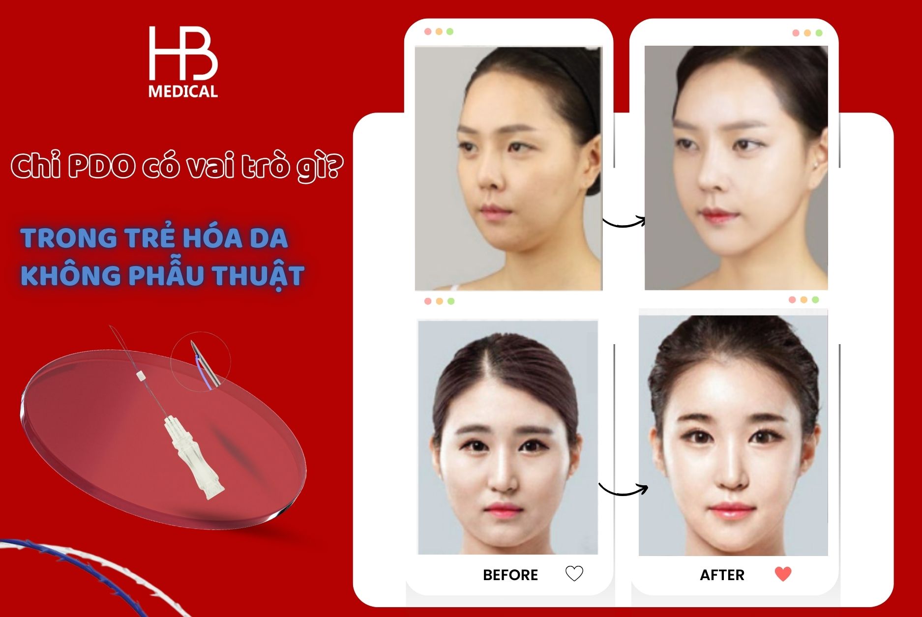 Chỉ PDO có vai trò gì trong trẻ hóa da không phẫu thuật?