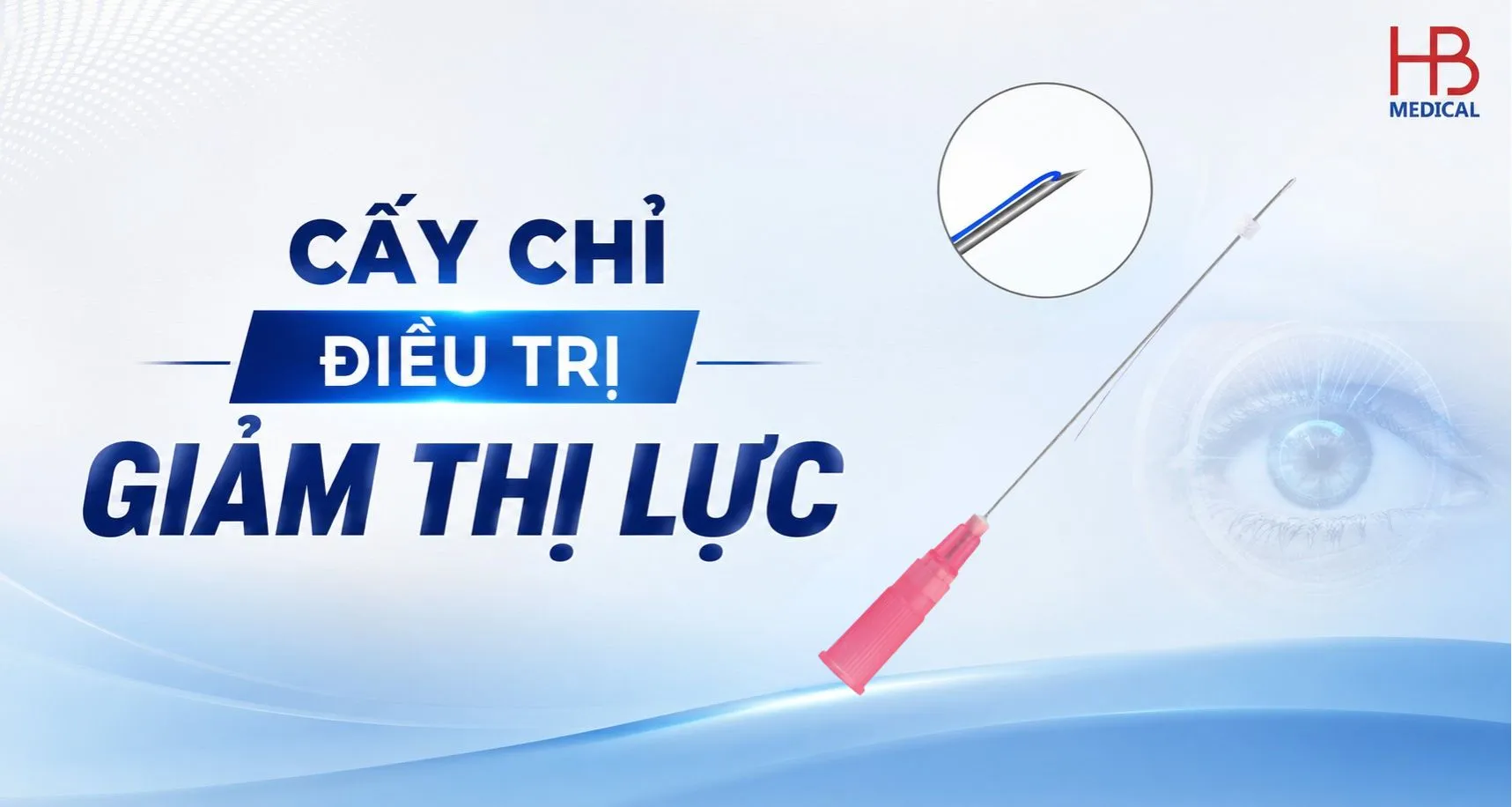 Cấy chỉ điều trị giảm thị lực hỗ trợ phục hồi theo Y học cổ truyền