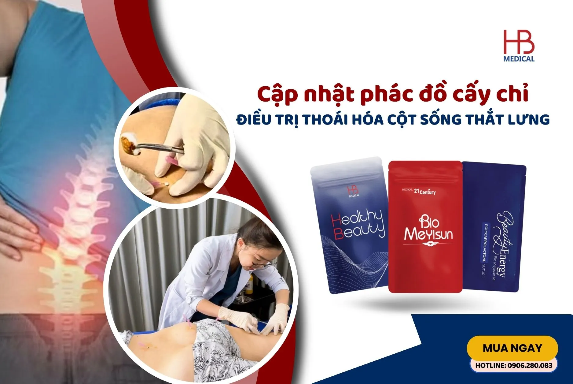 Cập nhật phác đồ cấy chỉ hỗ trợ điều trị thoái hóa cột sống thắt lưng cho bác sĩ YHCT