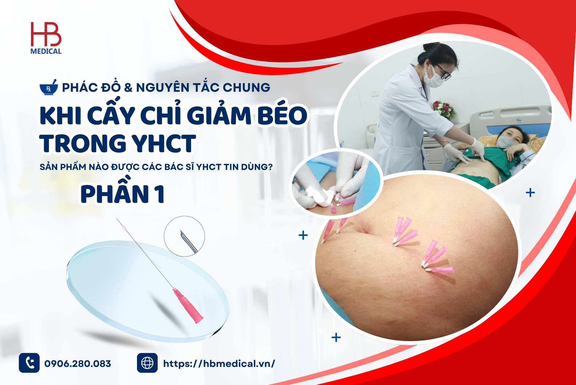 Phác đồ & nguyên tắc chung khi cấy chỉ giảm béo trong YHCT - Sản phẩm nào được các bác sĩ YHCT tin dùng ( Phần 1)
