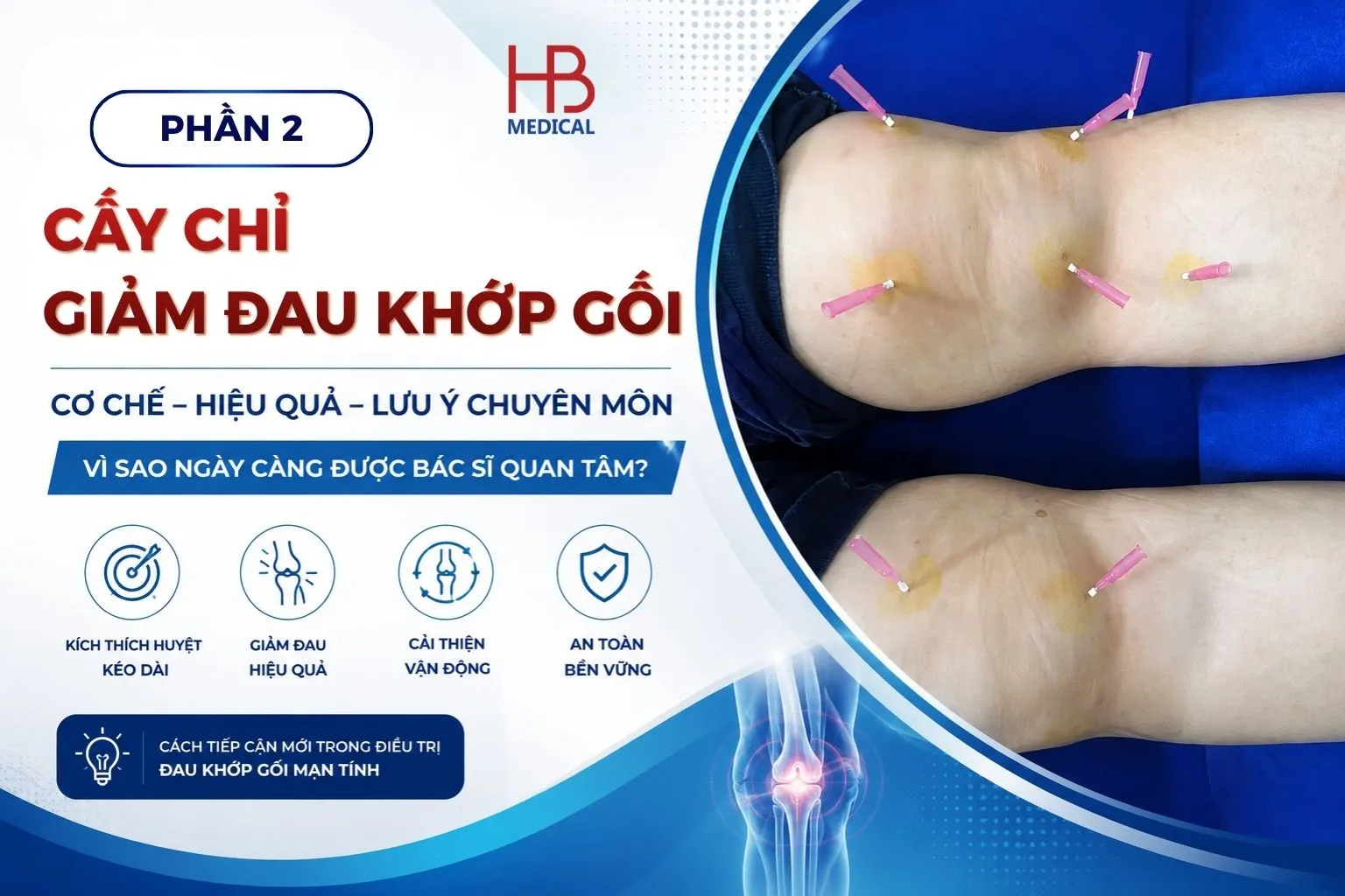 Cấy chỉ hỗ trợ giảm đau khớp gối như thế nào? Vì sao ngày càng được nhiều bác sĩ quan tâm?