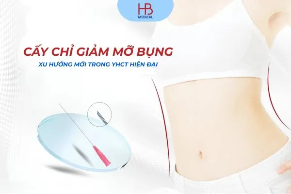 Cấy chỉ giảm mỡ bụng – Xu hướng mới trong YHCT hiện đại