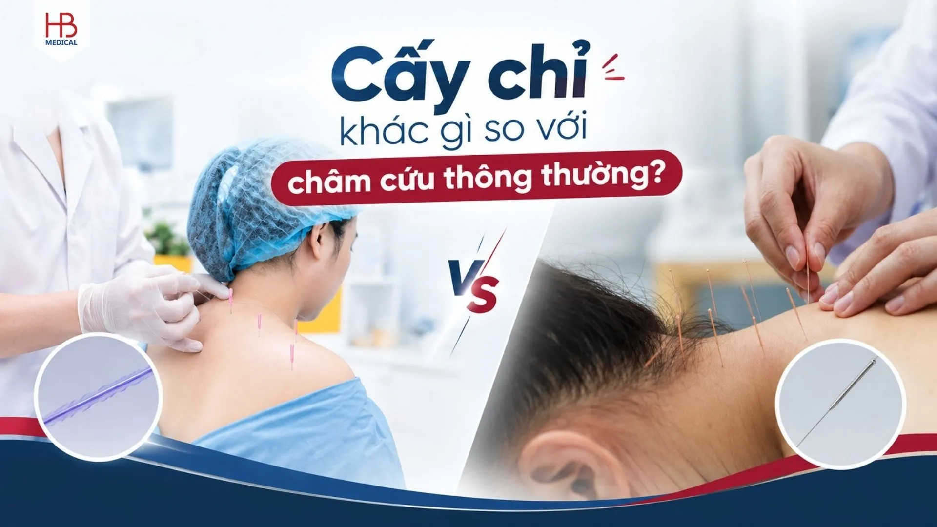 Cấy chỉ khác gì so với châm cứu thông thường?