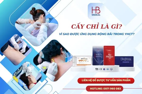 Cấy chỉ là gì? Vì sao ngày càng được ứng dụng rộng rãi trong YHCT & thẩm mỹ?