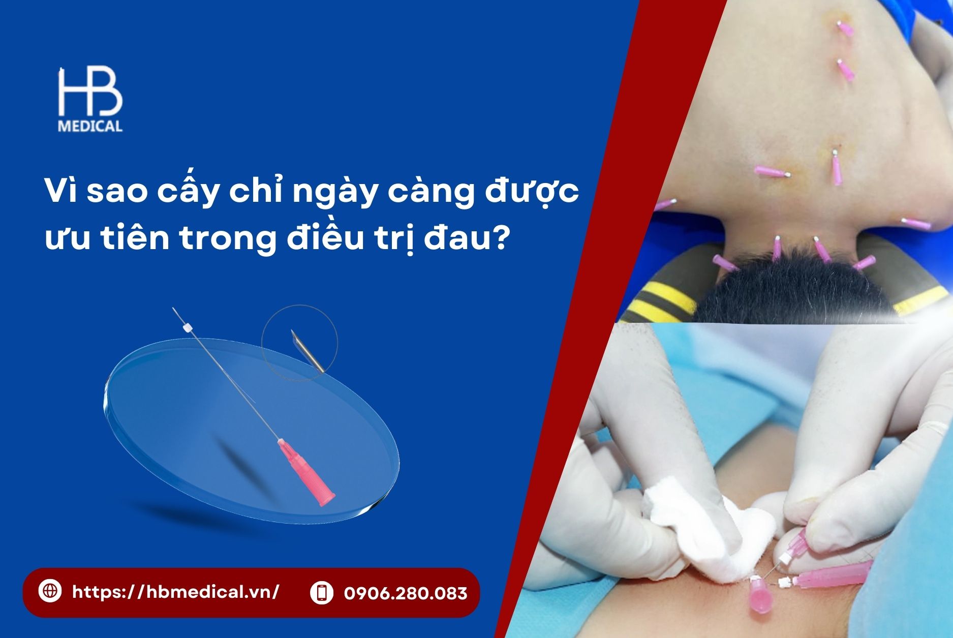 Vì sao cấy chỉ ngày càng được ưu tiên trong điều trị đau?