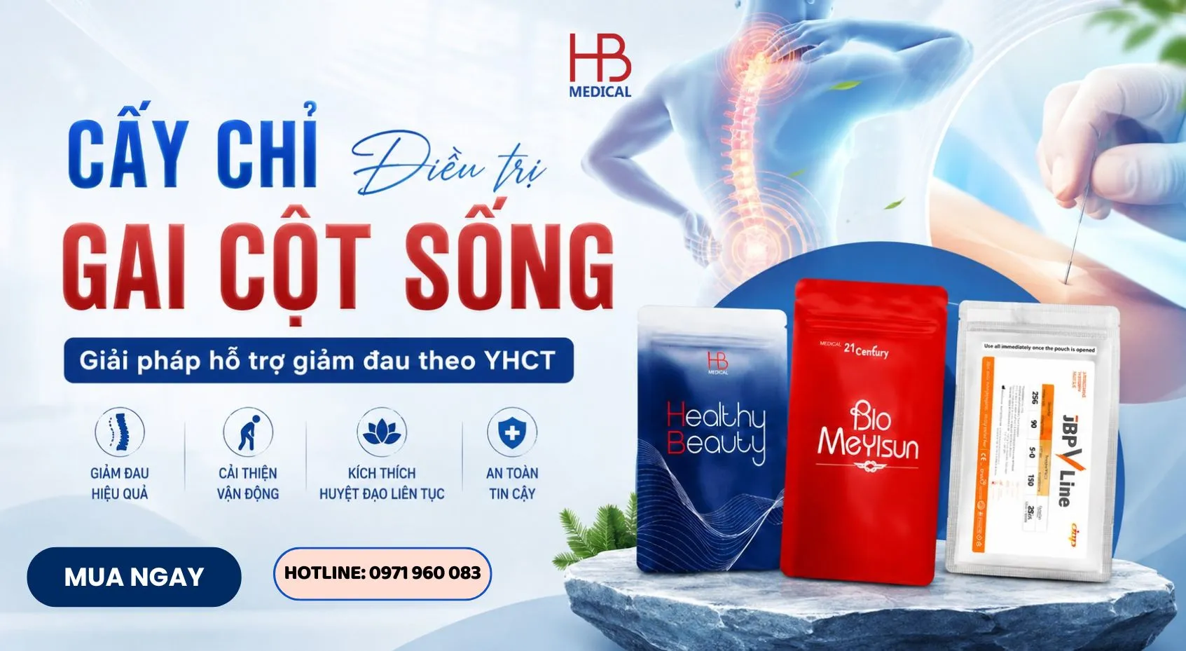 Cấy chỉ điều trị gai cột sống – Giải pháp hỗ trợ giảm đau theo YHCT