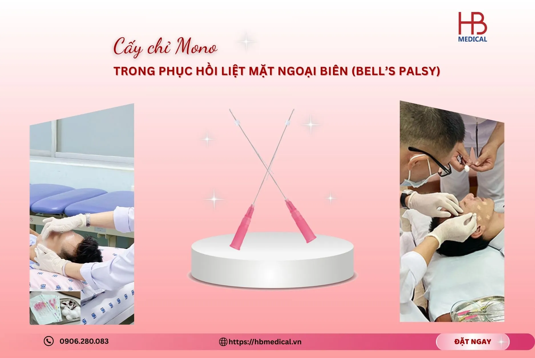 Cấy chỉ Mono trong phục hồi liệt mặt ngoại biên (Bell’s palsy)
