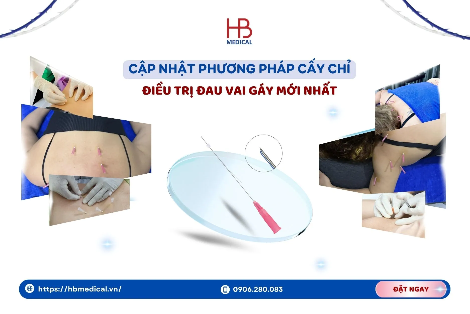 Cập nhật phương pháp cấy chỉ điều trị đau vai gáy mới nhất - các bác sĩ không thể bỏ qua