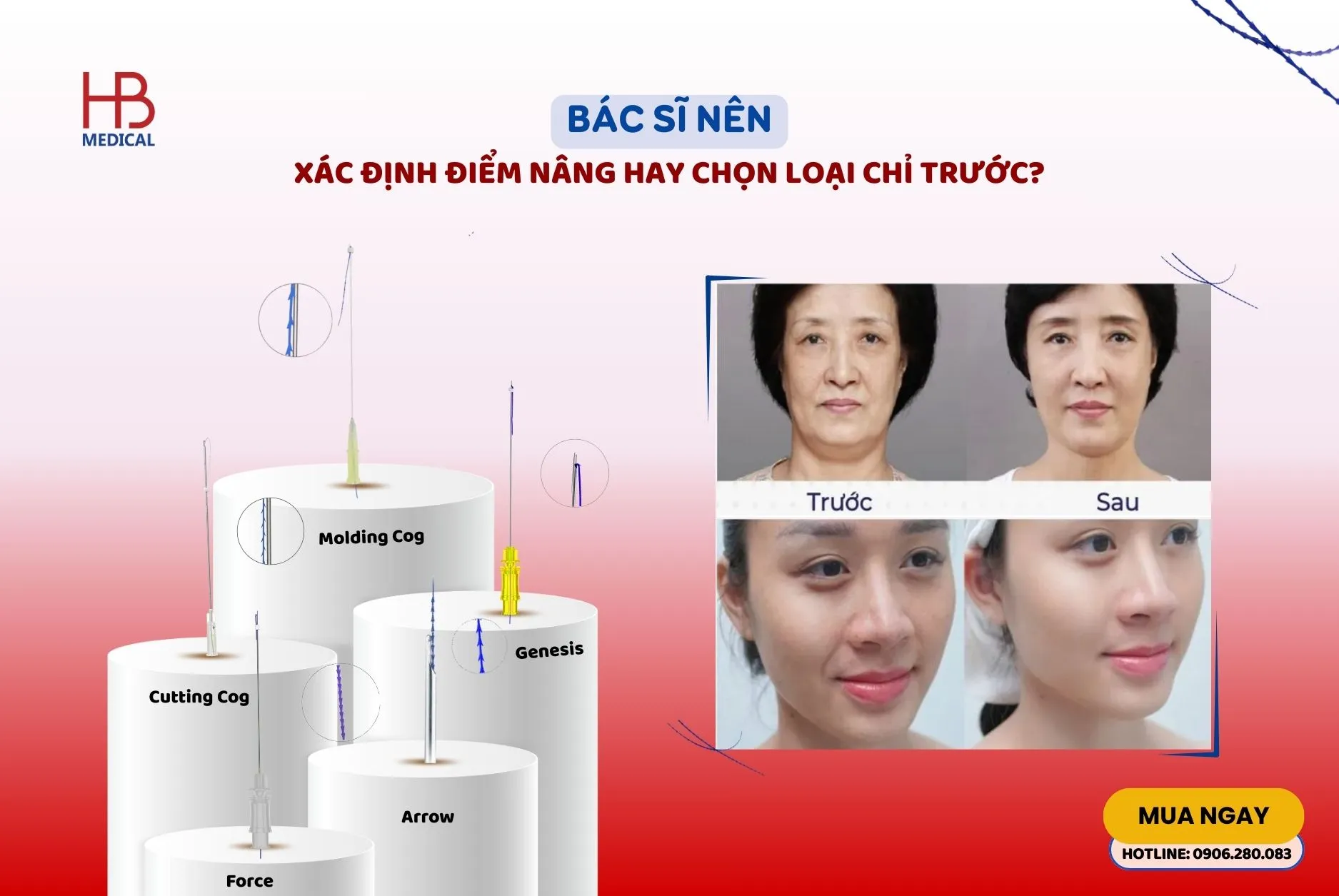 Bác sĩ nên xác định điểm nâng hay chọn loại chỉ trước?