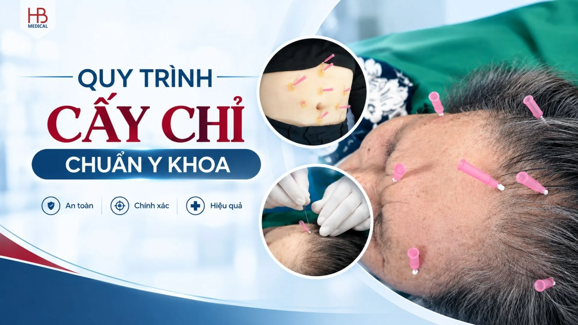 Quy trình cấy chỉ điều trị bệnh theo Bộ Y tế: Hướng dẫn dành cho bác sĩ YHCT